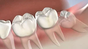 Cirugías dentales